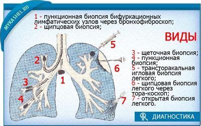 Возможные последствия налета на легких