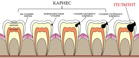 Кариес как основная причина образования свища