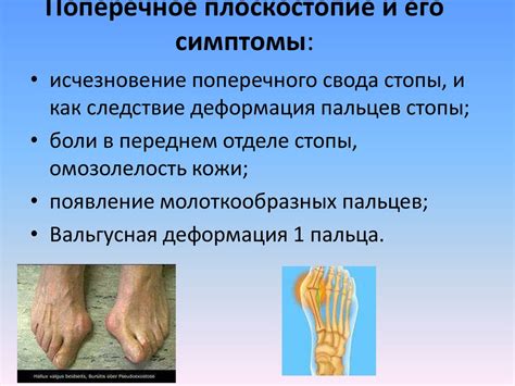 Плоскостопие и другие деформации стоп