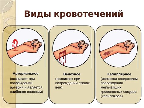 Правильные методы остановки кровотечения