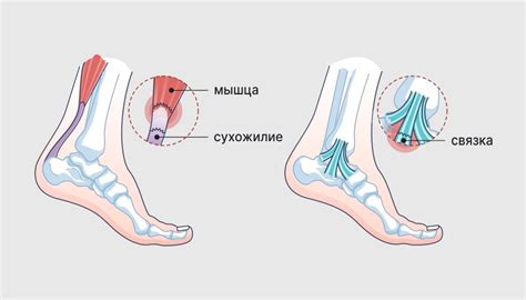 Растяжение сухожилий пятки