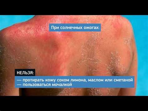 Солнечные ожоги - серьезная проблема
