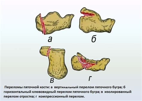 Травмы и ушибы пятки