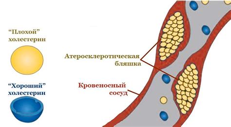 Физическая активность и снижение уровня холестерина