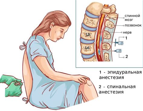 Эпидуральная анестезия при родах
