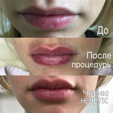 Важные факты о принятии антибиотиков после увеличения губ