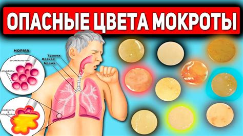 Возможные причины мокроты после пневмонии