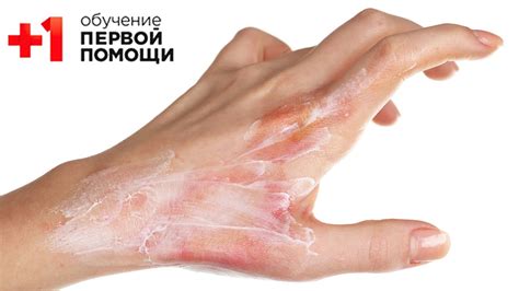 Ожоги и перекись