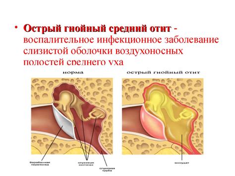 Острый гнойный отит: когда можно начинать нагрузки