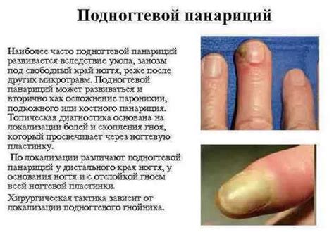 Отзывы пациентов: какими методами они быстро справились с гноем на пальце
