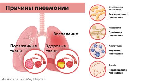 Пневмония: симптомы, причины и лечение