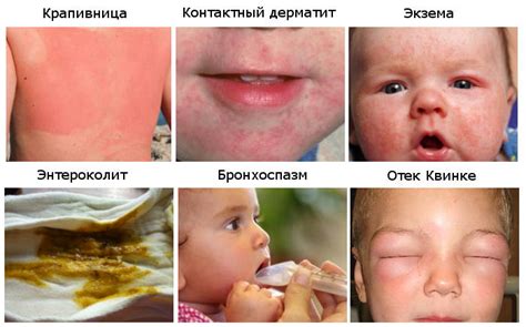 Повышение риска аллергии у ребенка