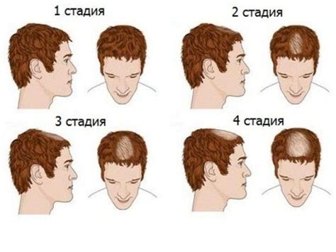Процесс облысения у мужчин