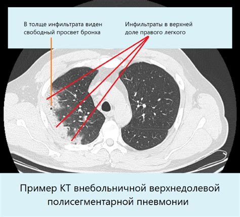 Симптомы мокроты после пневмонии